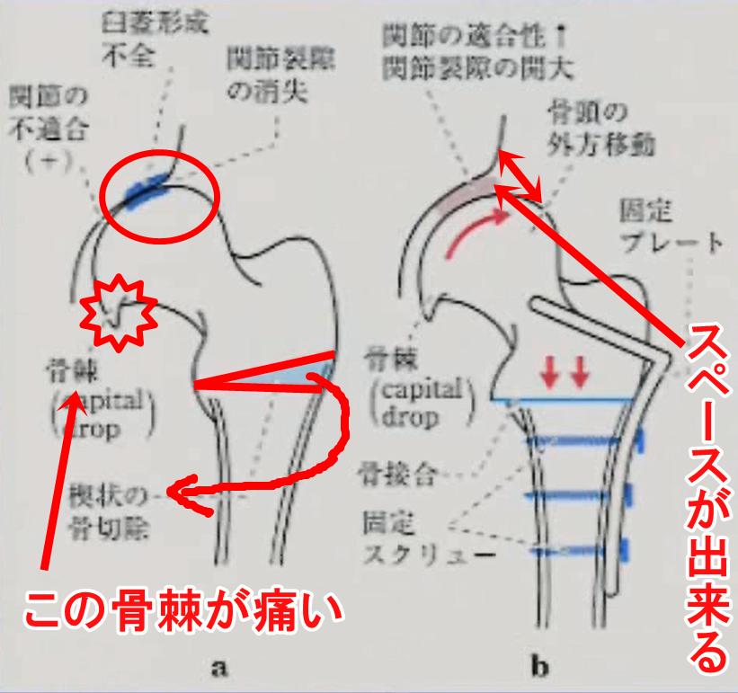 外反骨切り術