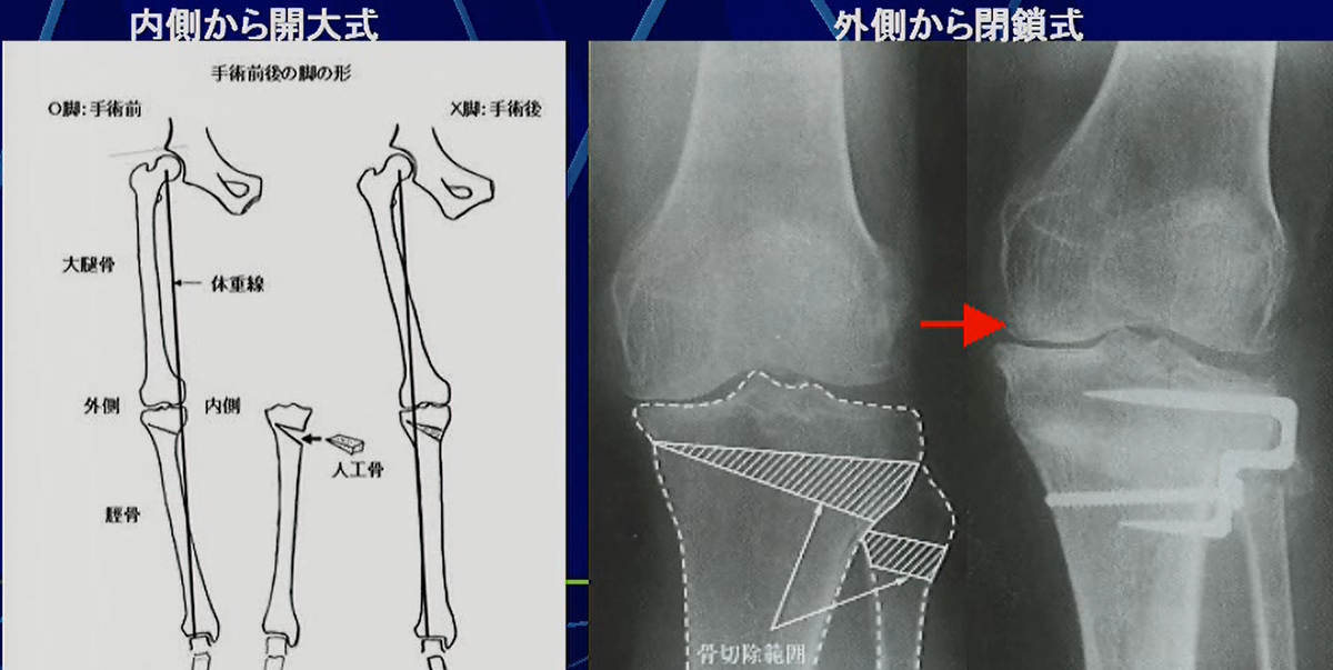 骨切り術