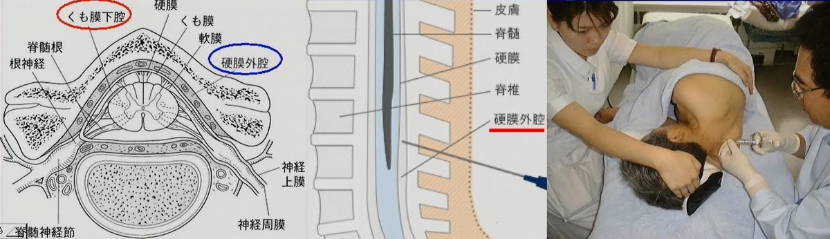 硬膜外腔ブロック