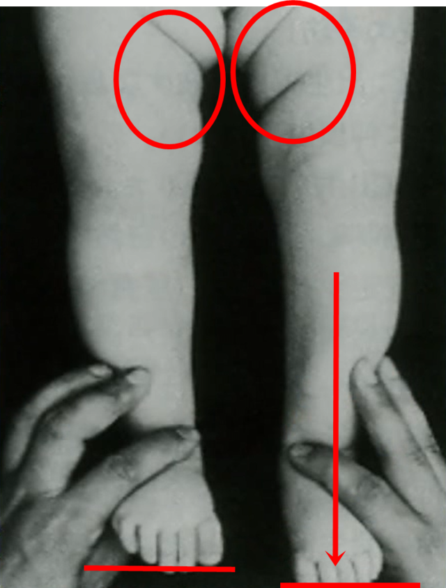 大腿皮膚構の非対称
