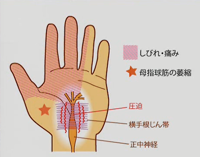 手根管症候群の問診