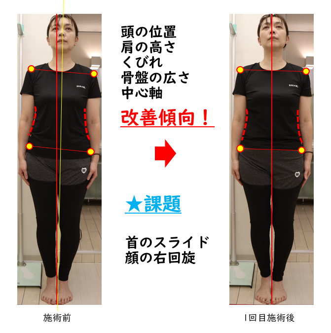 美容整体ビフォーアフター姿勢
