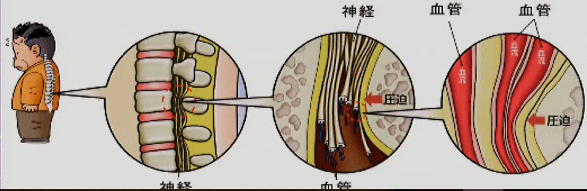 腰椎症　神経性間欠跛行のしくみ