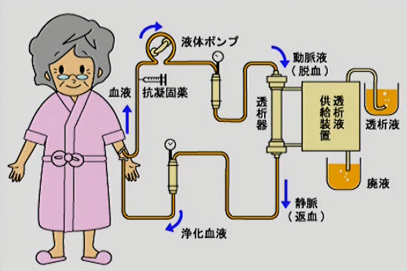 アミロイドの沈着