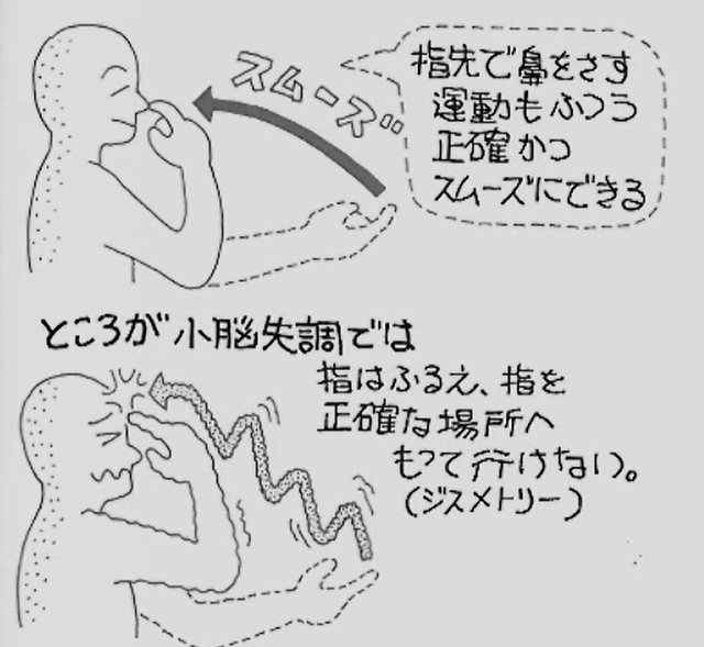 小脳性運動失調