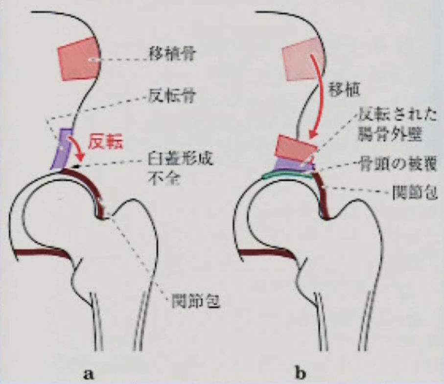 棚形成術