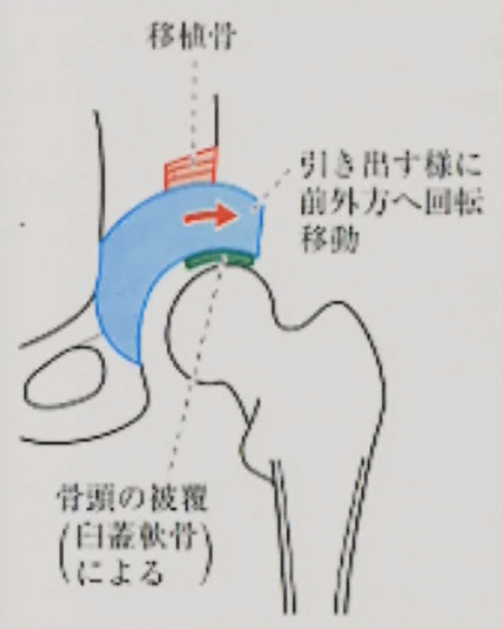 寛骨臼回転骨切り術