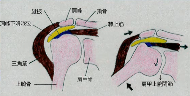 鑑別疾患　肩関節周囲炎(五十肩)