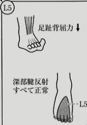 Ｌ５神経根圧迫　整形外科学テスト　神経学的テスト(高位診断)