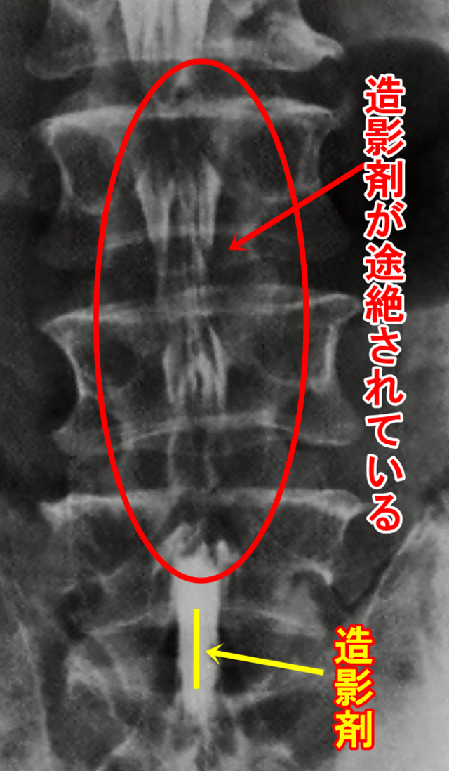 先天性(発育性)脊柱管狭窄