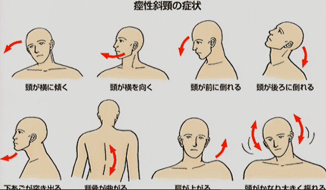 後天性痙性斜頚