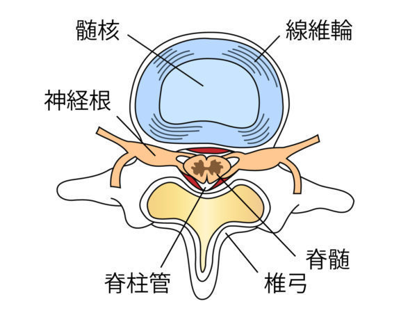 腰椎椎間板ヘルニアの原因と症状