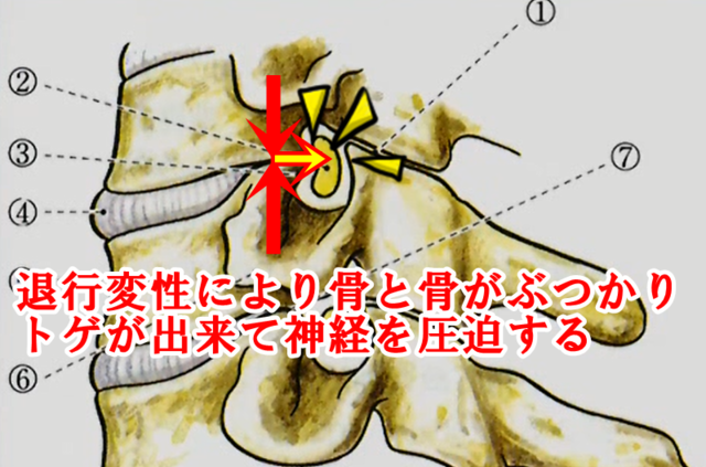 ルシュカ関節が退行変性