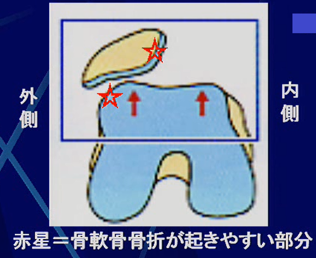 膝蓋骨の脱臼(外傷性)