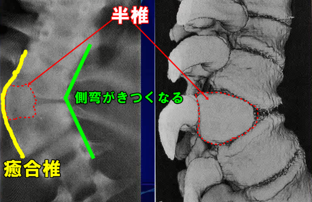 潜在性脊椎披裂先天性側弯症