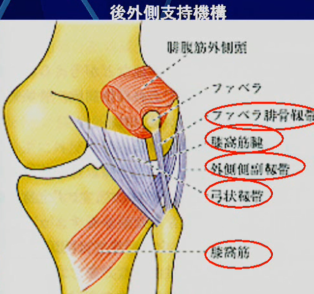 後外側支持機構(ＬＣＬ)損傷