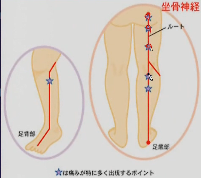 ヴァレー圧痛点　整形外科学テスト　オーソペディックテスト