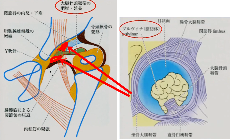 関節内脂肪線維組織(プルヴィナ)