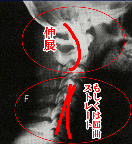 ストレートネック