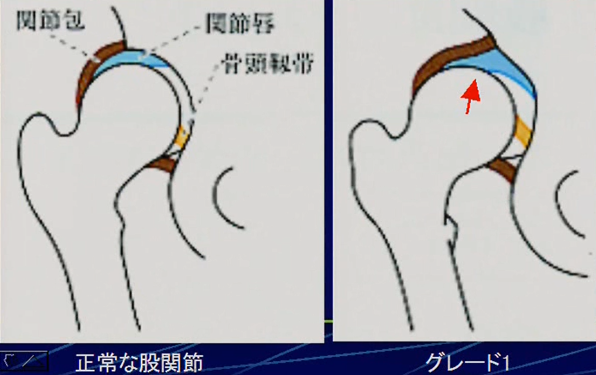 解剖学的グレード分類