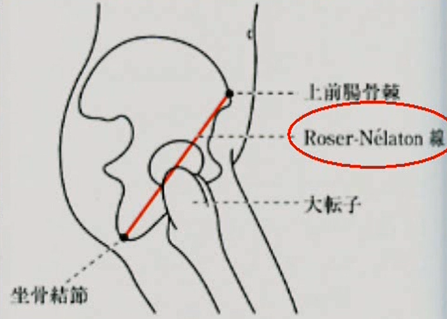 大転子の位置異常