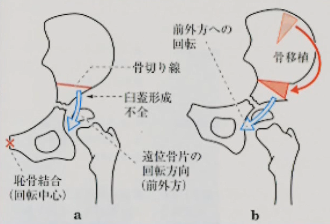 ソルター手術