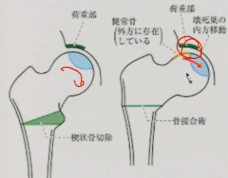 内反骨切り術