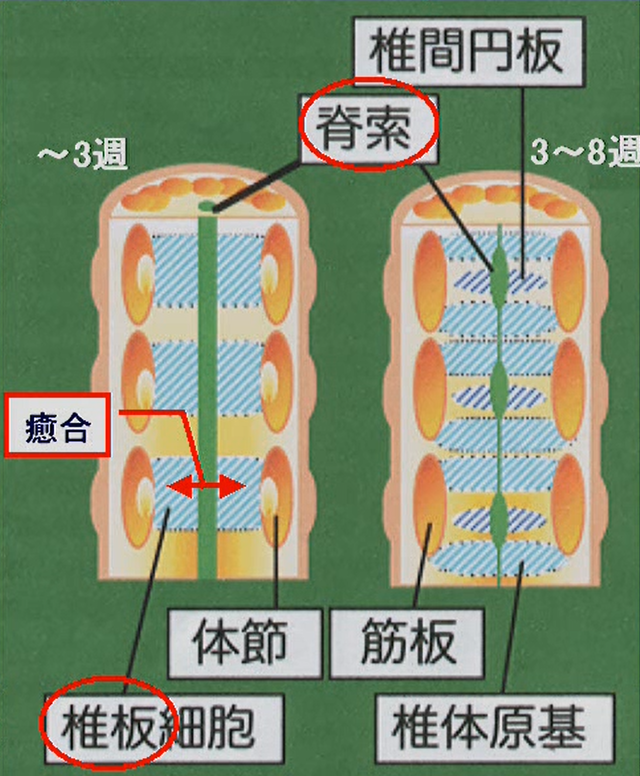 脊柱原基の形成・癒合の障害