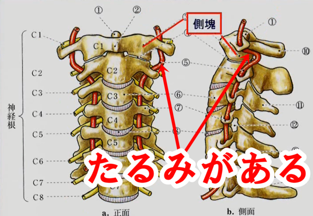 椎骨動脈のたるみ