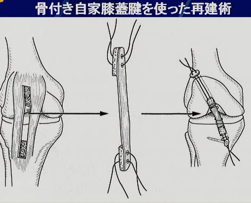 前十字靭帯(ＡＣＬ)損傷