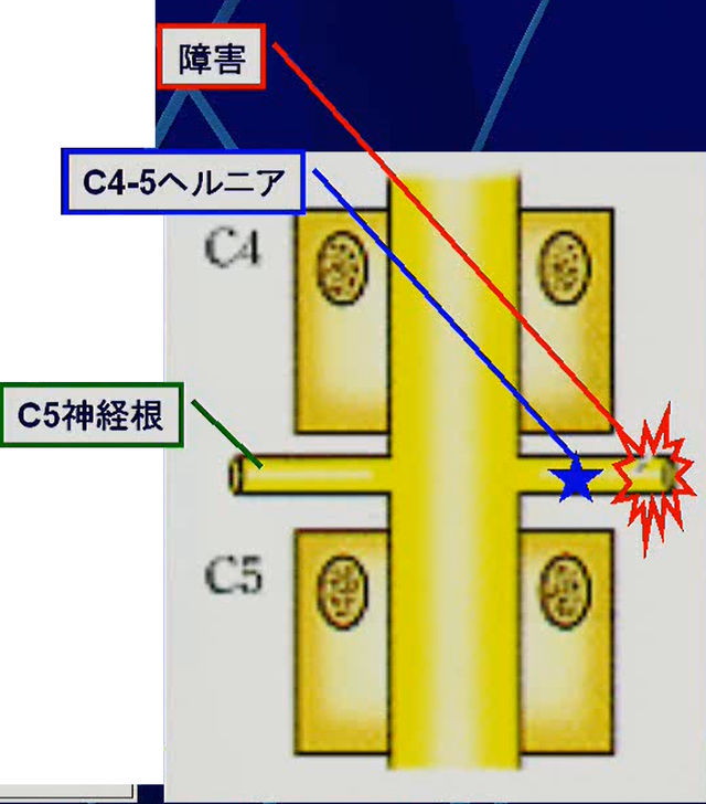 整形外科的テスト　神経学的テスト