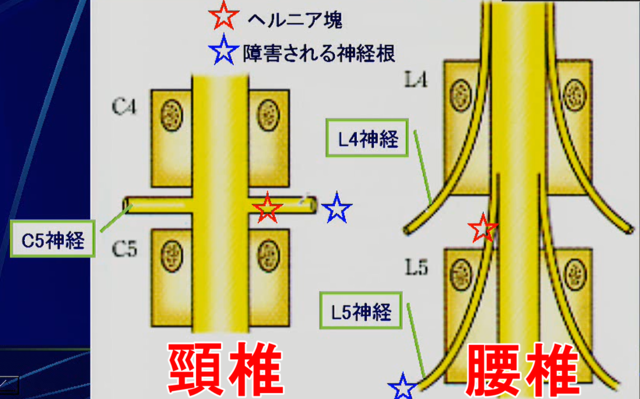 圧迫される神経根