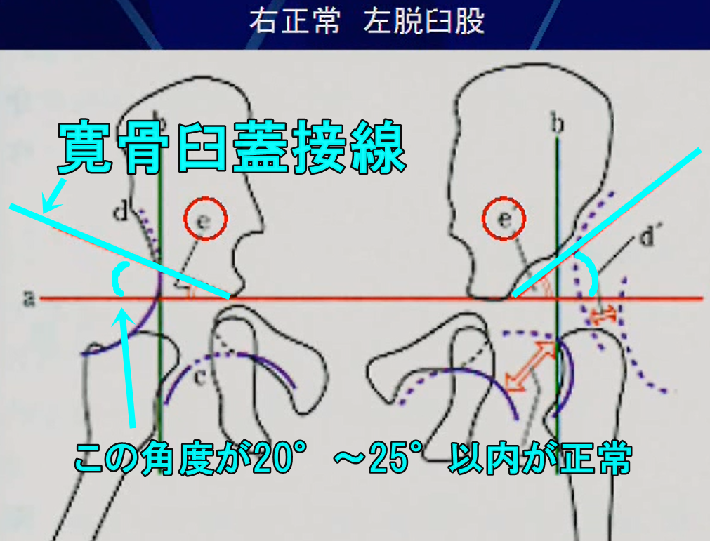 臼蓋傾斜角