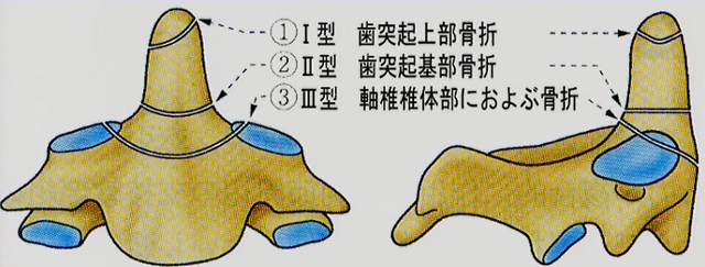 歯突起骨折