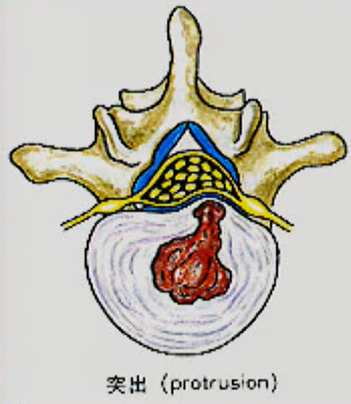 椎間板ヘルニア　突出