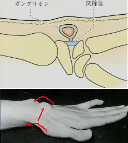 ガングリオン(良性腫瘍)