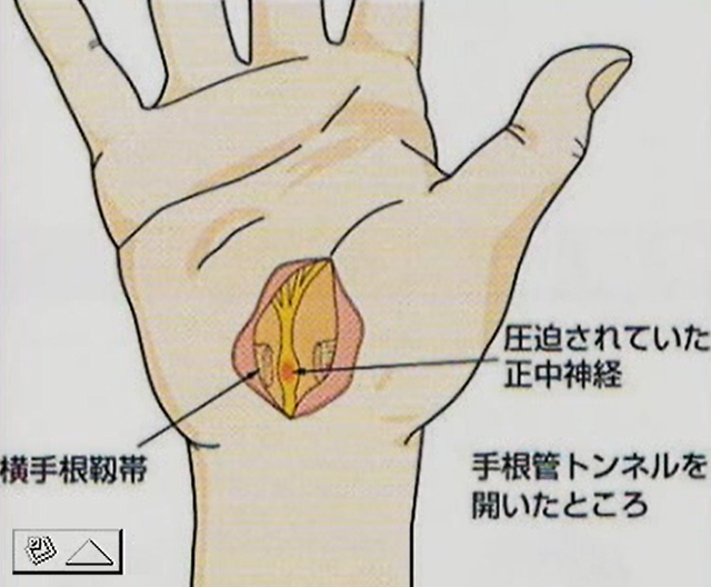 屈筋支帯の切断