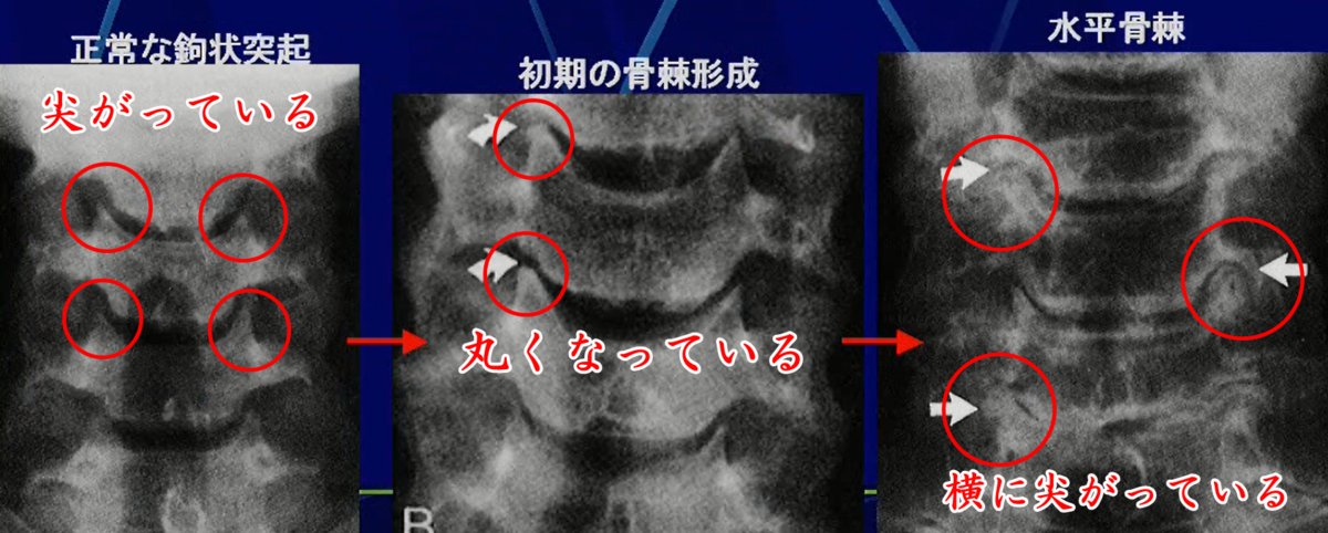 鉤状突起の水平骨棘のレントゲン画像