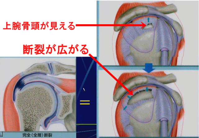 全層(完全)断裂