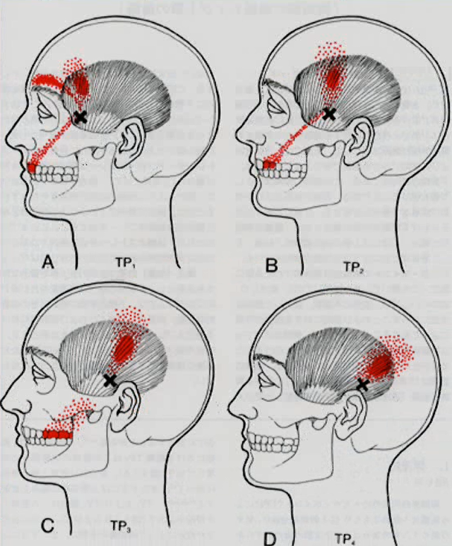 側頭筋の関連痛