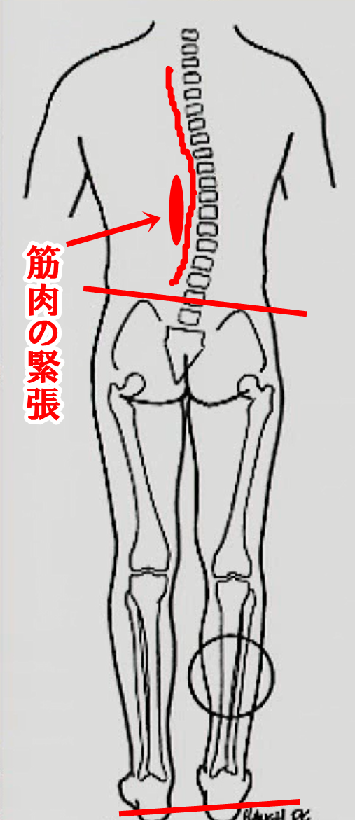 代償性側弯