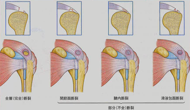 部分(不全)断裂