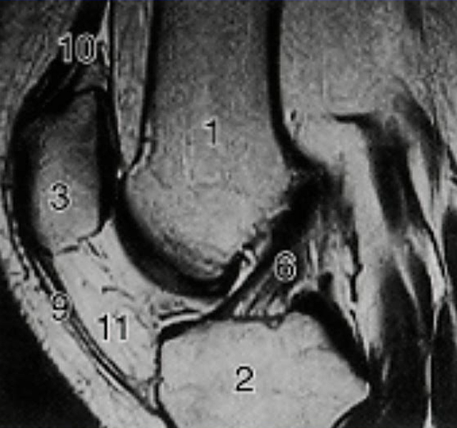 ＭＲＩで膝を横から見た画像