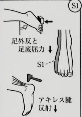 Ｓ１神経根圧迫　整形外科学テスト　神経学的テスト(高位診断)