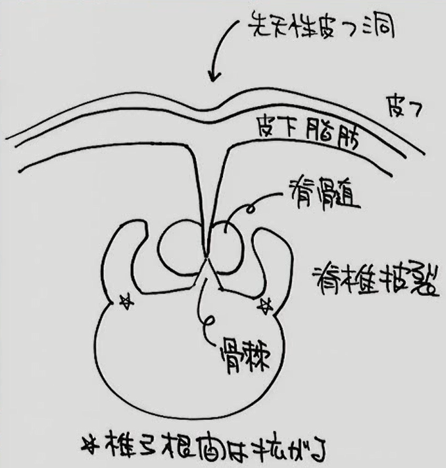 脂肪腫(脊髄脂肪髄膜瘤),脊髄正中離開症　