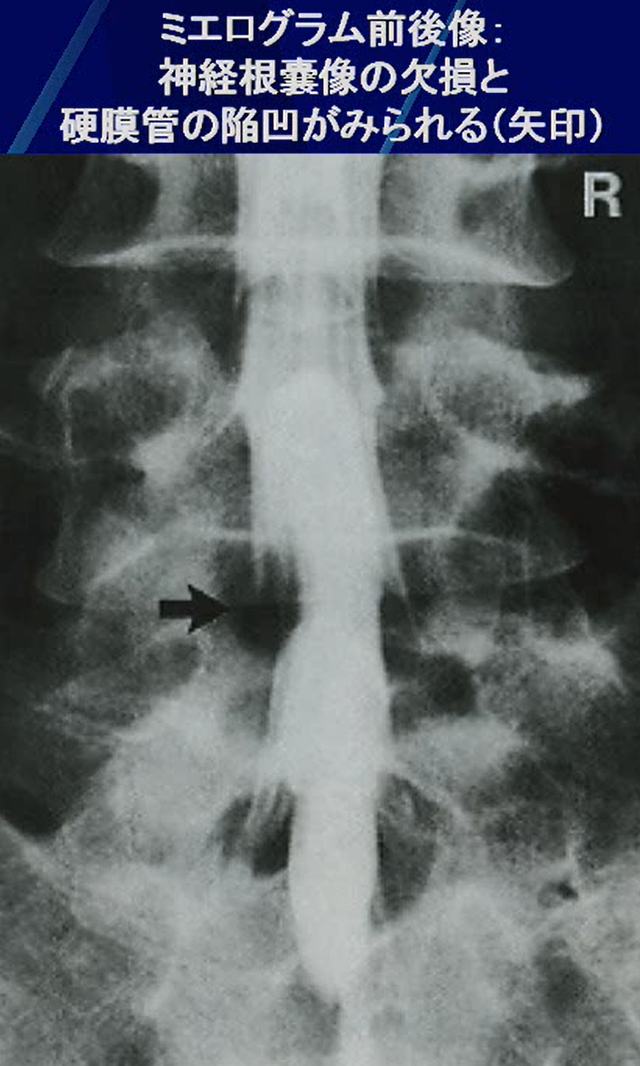 脊髄造影(ミエログラフィー)の画像