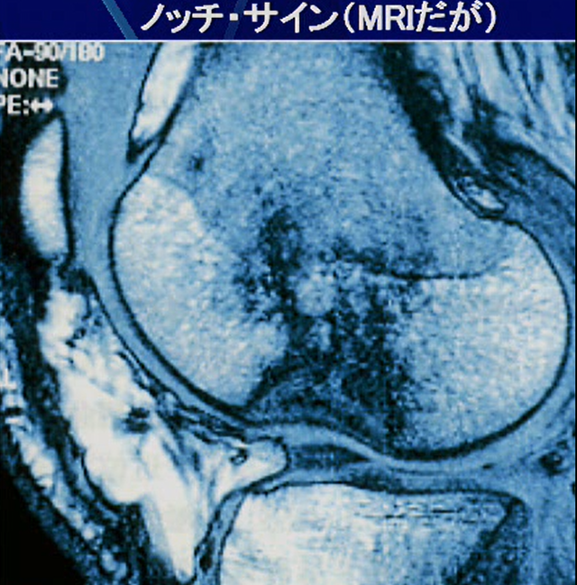 前十字靭帯(ＡＣＬ)損傷の画像