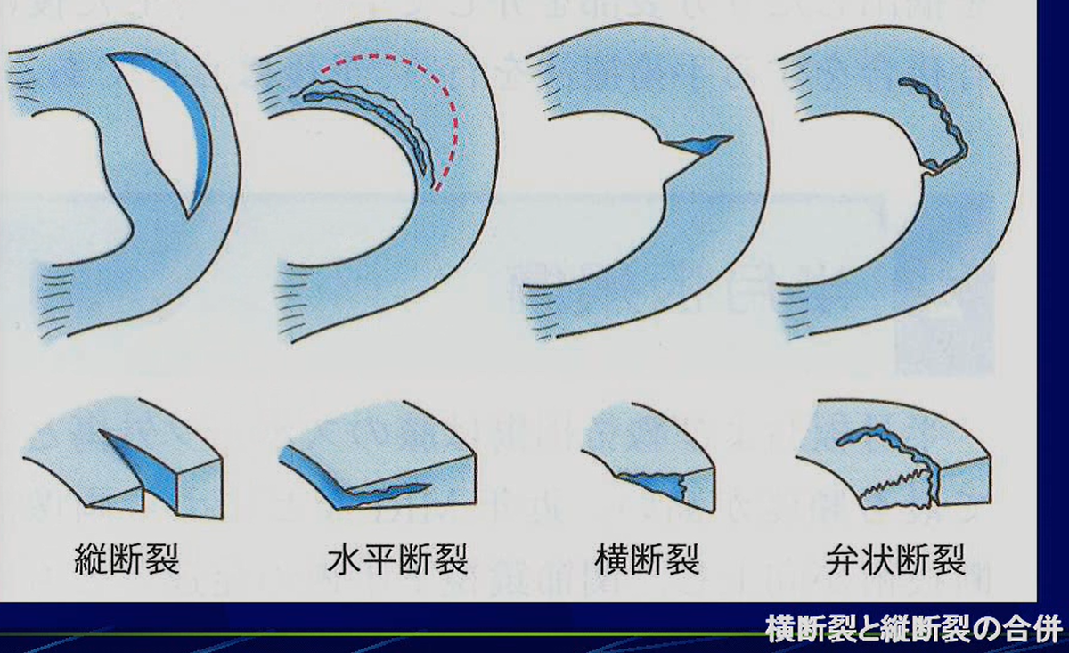 半月板損傷の世代別に多いパターン