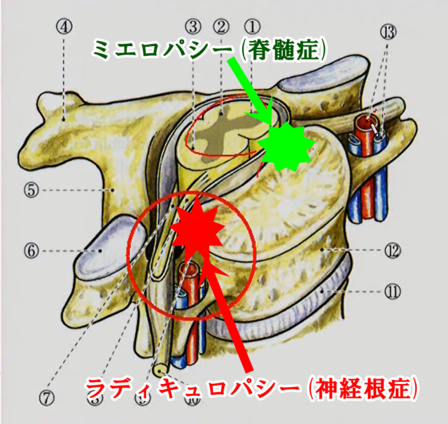 ミエロパシー(脊髄症)とラディキュロパシー(神経根症)