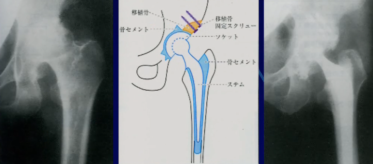 セメント使用型